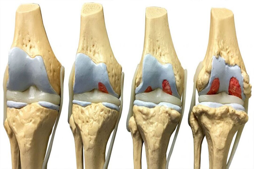 Stages of osteoarthritis development