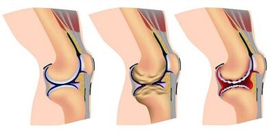 Development stages of the arthrosis of the knee joint
