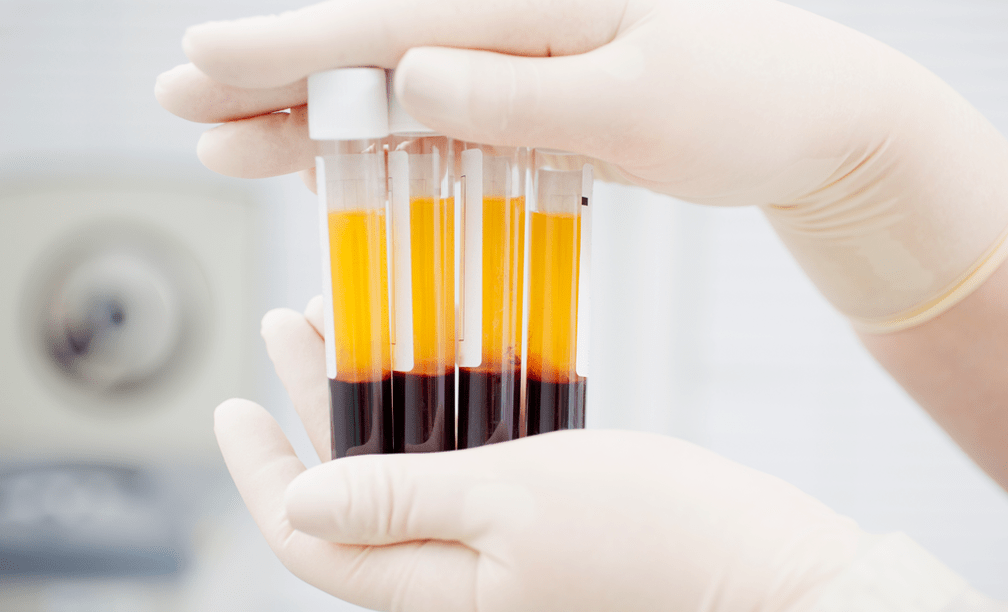 Platelet-rich plasma for PRP therapy for osteoarthritis